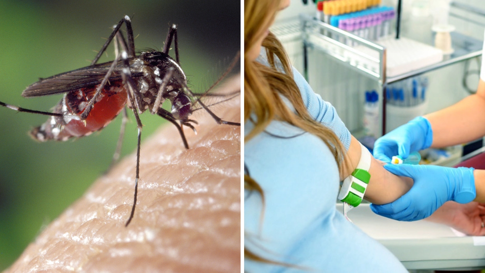 La malattia portata dalla zanzara Aedes (al centro) può provocare rush e dolore intenso alla testa e dietro agli occhi