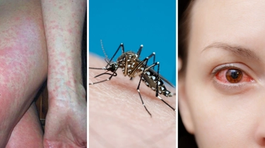 Cos’è la febbre Dengue, il virus portato dalle zanzare Aedes appena scoperto in Lombardia: sintomi, cura, mortalità