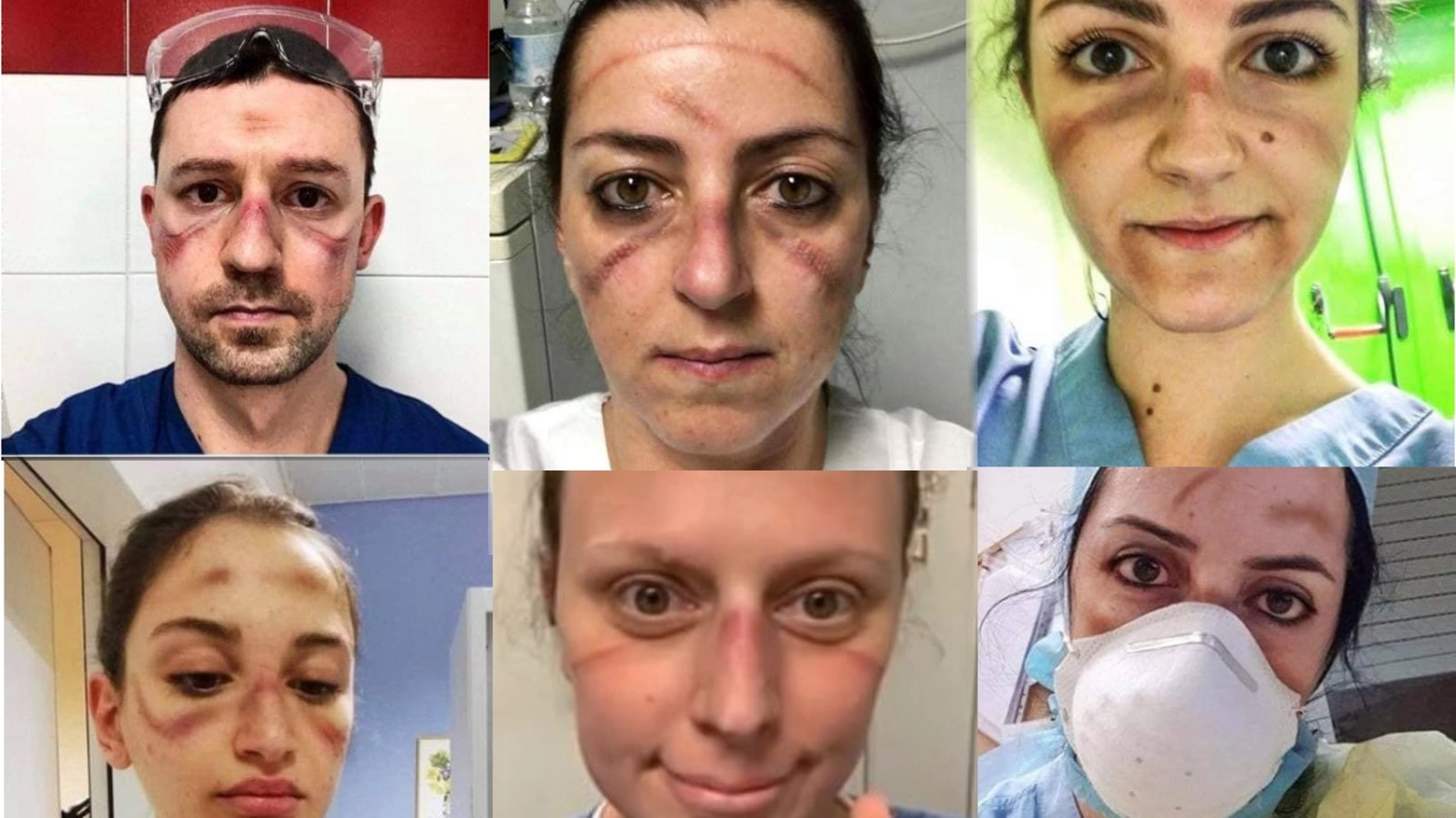Il sindacato Nursing up fotografa i volti degli infermieri con le lesioni da mascherina