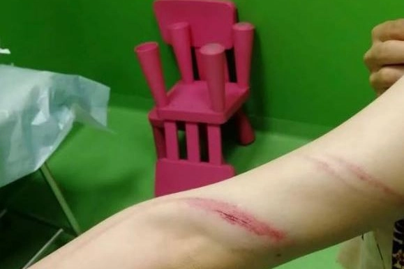 FERITE I lividi sul braccio di Aida: sono i segni delle cinghiate che il marito le dava ogni giorno