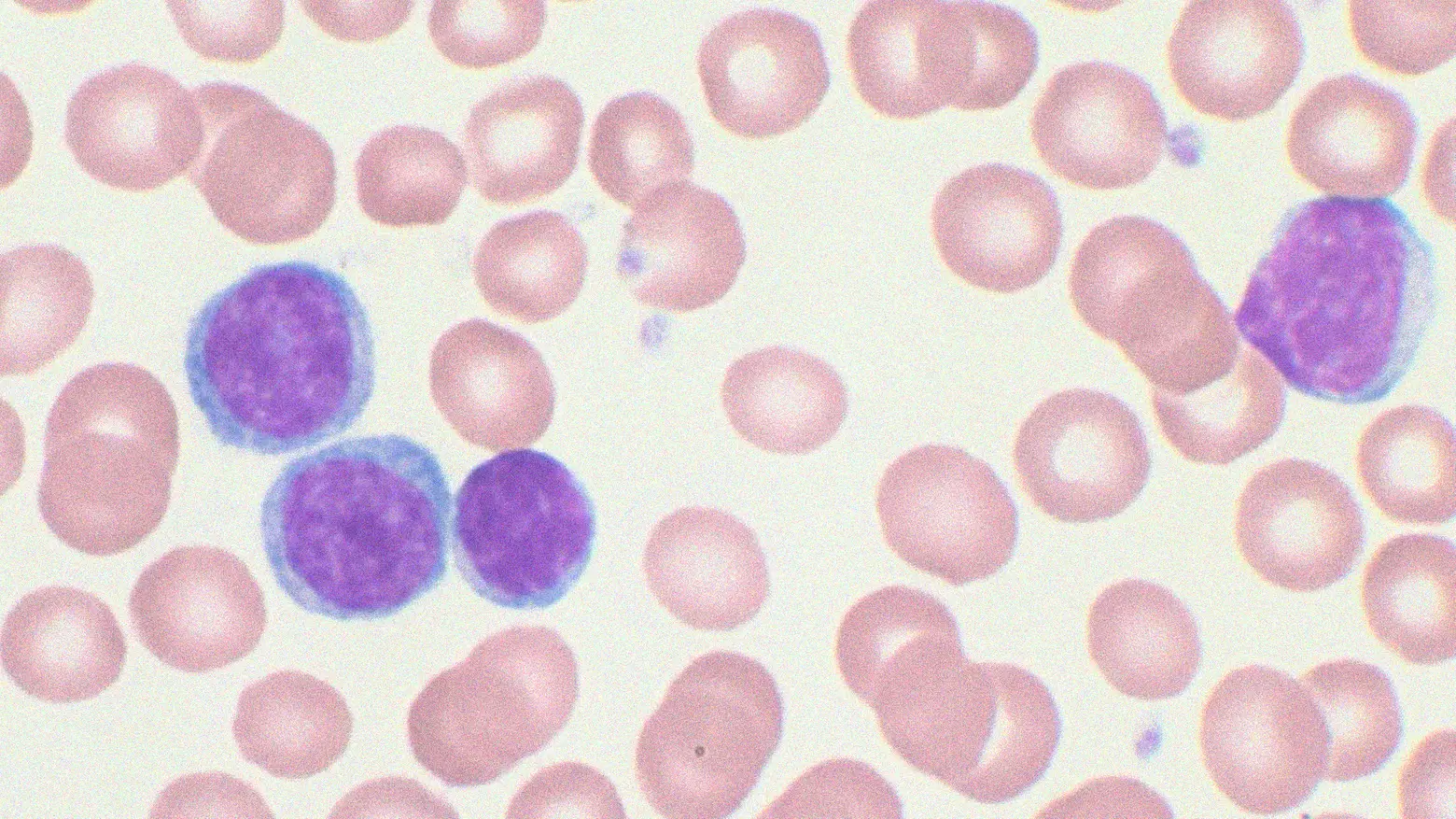 Cellule colpite da leucemia mieloide acuta al microscopio