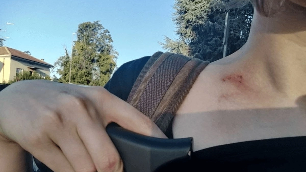 I segni dell'aggressione sul collo di Noemi