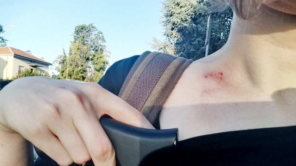 Noemi mostra i segni lasciati sul collo dall’aggressione che ha subito a Pavia