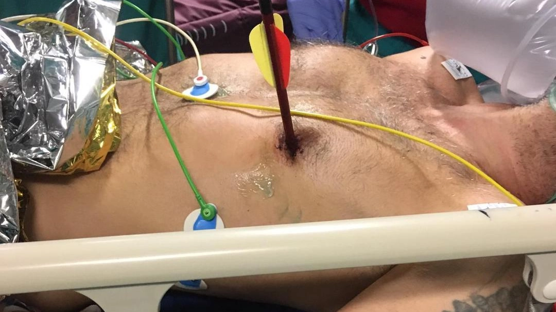 Paziente in sala operatoria, torace trafitto da una freccia (Ansa)