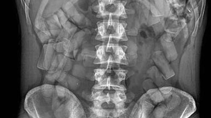 Radiografia che mostra la presenza di droga nella pancia