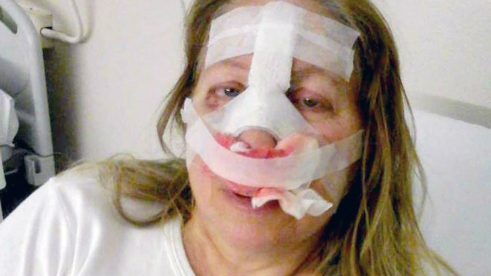 Maria Monteverde ha riportato la frattura del setto nasale