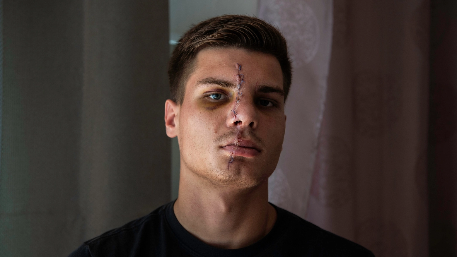 Le ferite sul volto di Danylo Shydlovskyi