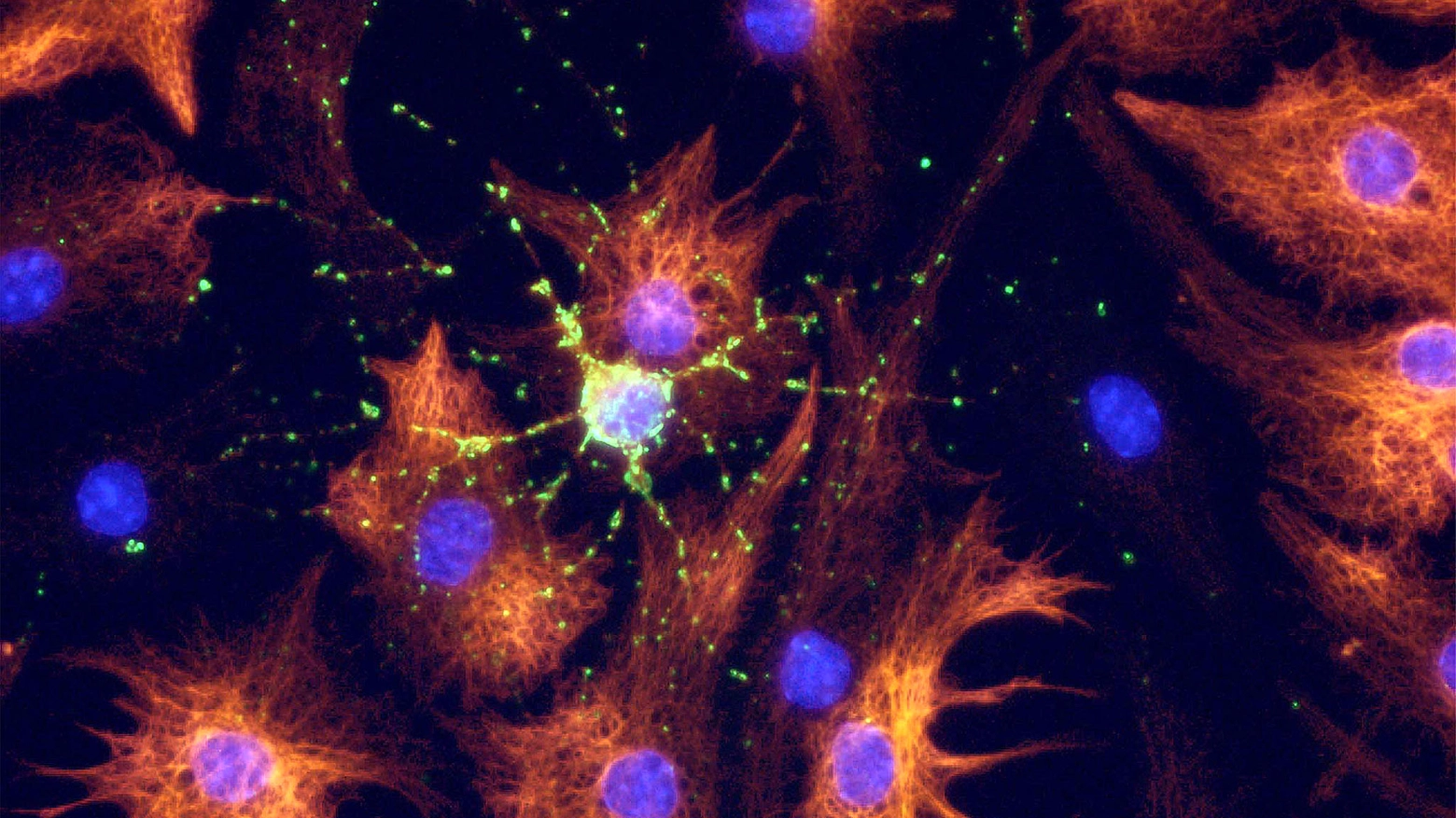 Cellule staminali per bloccare la sclerosi