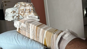 Frattura bloccata col cartone, scoppia il caso all’ospedale di Patti (Messina): mancavano le stecche