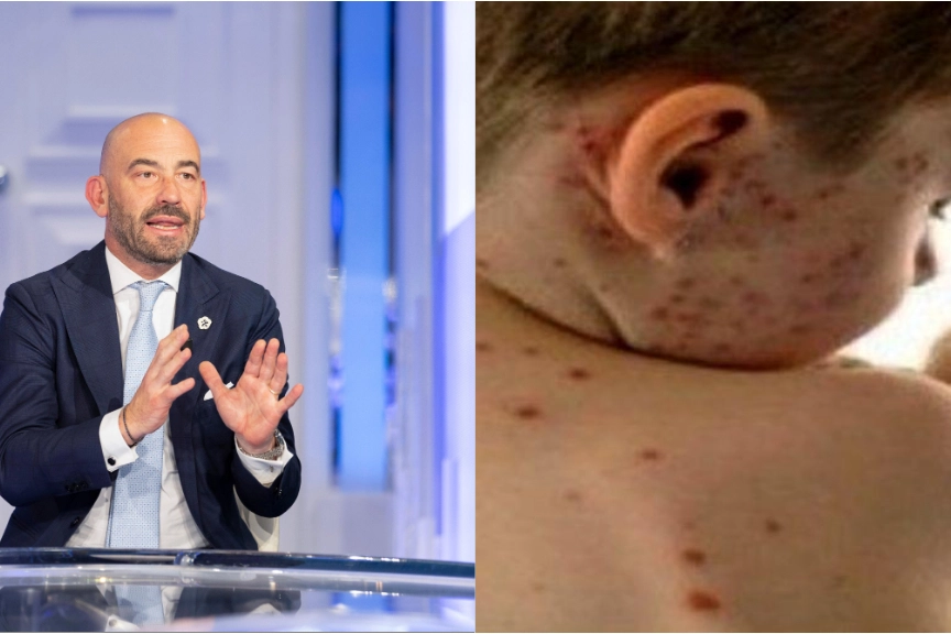 Bassetti: "E' partita l'epidemia di morbillo"