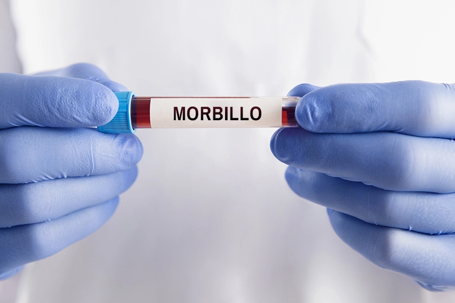Morbillo: torna l'allarme