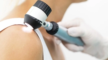 Melanoma, diagnosi precoce con l’intelligenza artificiale: a Milano un nuovo servizio dedicato alla mappatura dei nei