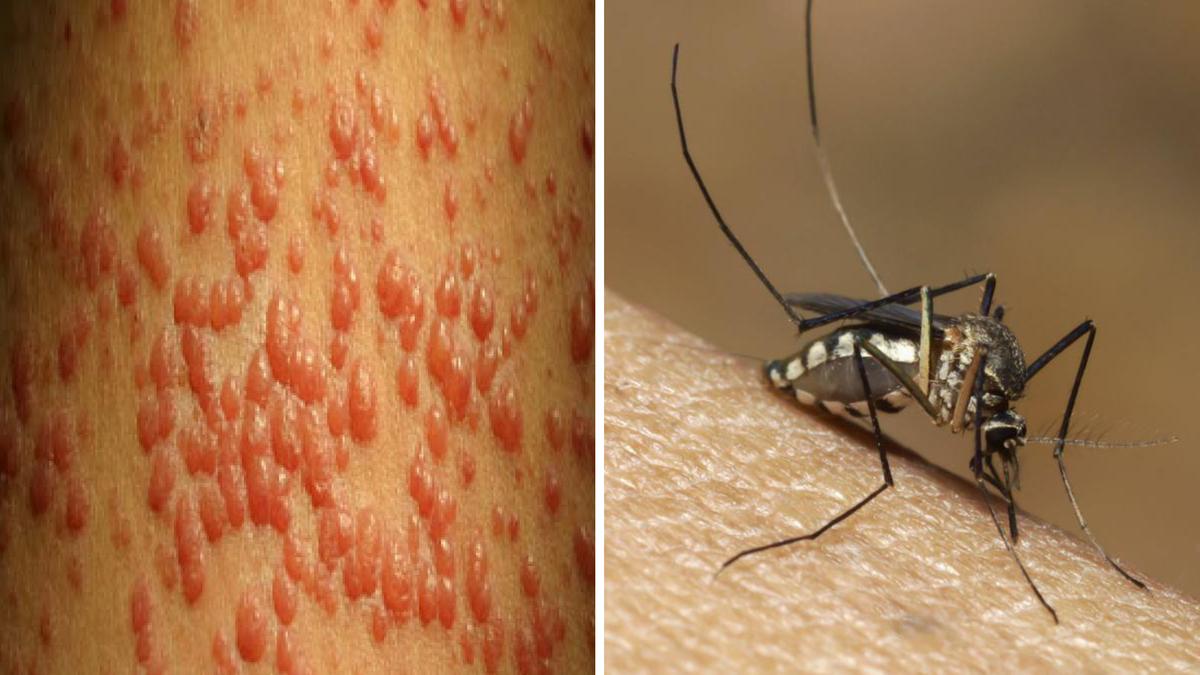 Contagio da virus Chikungunya a San Donato Milanese: scatta la disinfestazione straordinaria Contagio da virus Chikungunya a San Donato Milanese: scatta la disinfestazione straordinaria