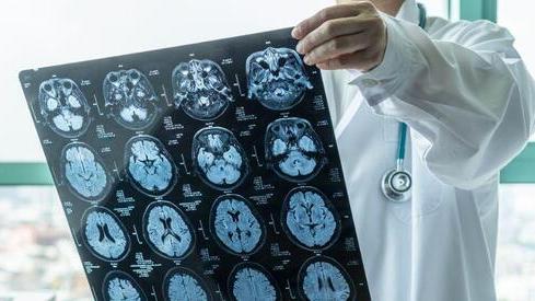 Alzheimer, il farmaco Leqembi (lecanemab) approvato in Europa. Il San Raffaele di Milano primo centro italiano a somministrarlo dal 2024
