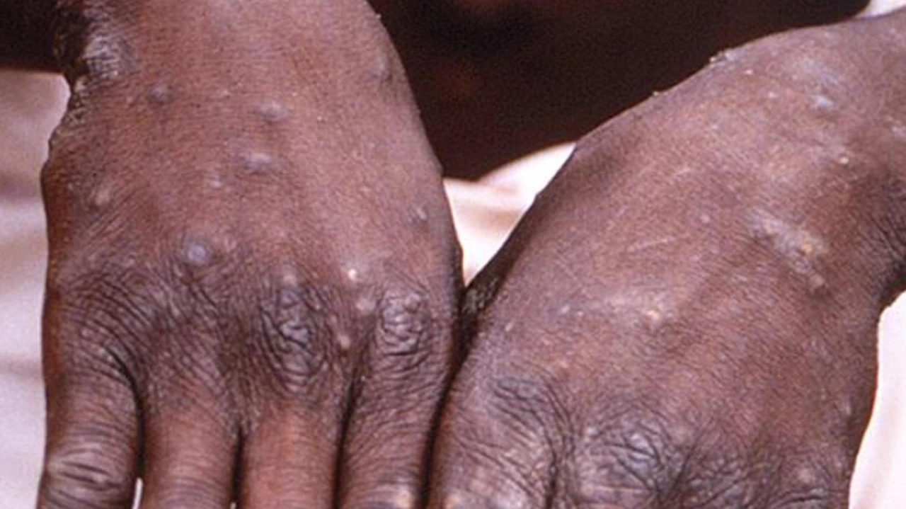 Le vescicole del Mpox possono essere di dimensione e numero variabile Le vescicole del Mpox possono essere di dimensione e numero variabile