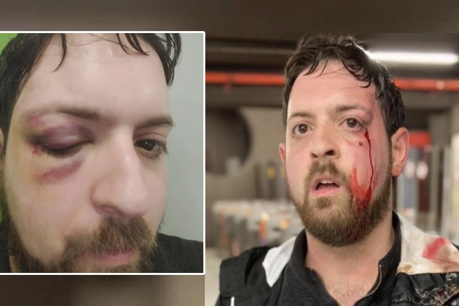 Matthia Pezzoni dopo l'aggressione subita il 23 aprile. Il presidente del comitato sicurezza di Milano era stato colpito a pugni dalle borseggiatrici
