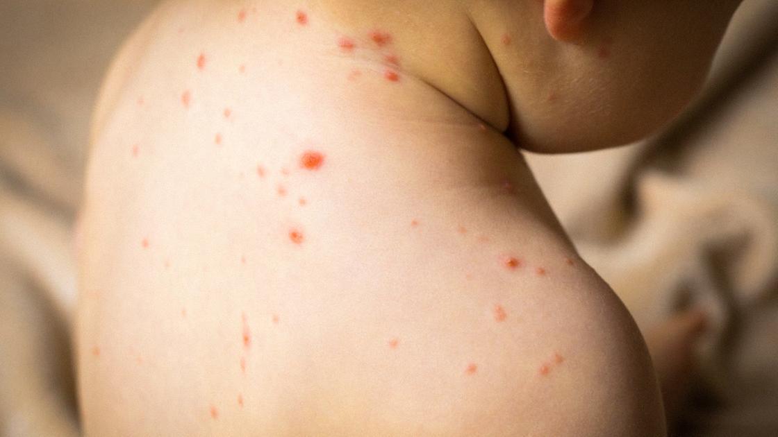 ritorna il morbillo la lombardia tra le regioni pi249 colpite attenti ai viaggi internazionali ci sono molti focolai in giro