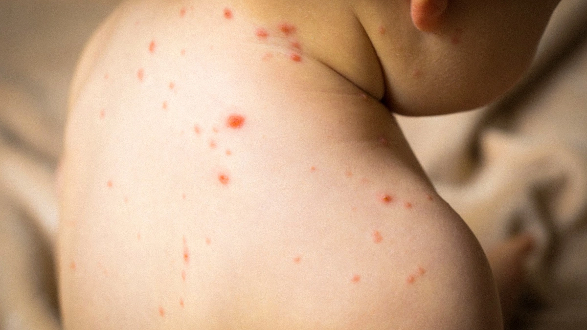 I tipici segni del morbillo