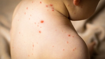 Ritorna il morbillo, la Lombardia tra le regioni più colpite: “Attenti ai viaggi internazionali, ci sono molti focolai in giro”