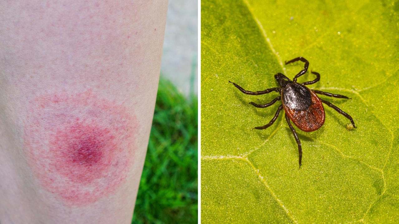 A sinistra, la caratteristiche macchia o papula rossa “a bersaglio” tipica della malattia di Lyme. A destra, una zecca portatrice dell'infezione A sinistra, la caratteristiche macchia o papula rossa “a bersaglio” tipica della malattia di Lyme. A destra, una zecca portatrice dell'infezione