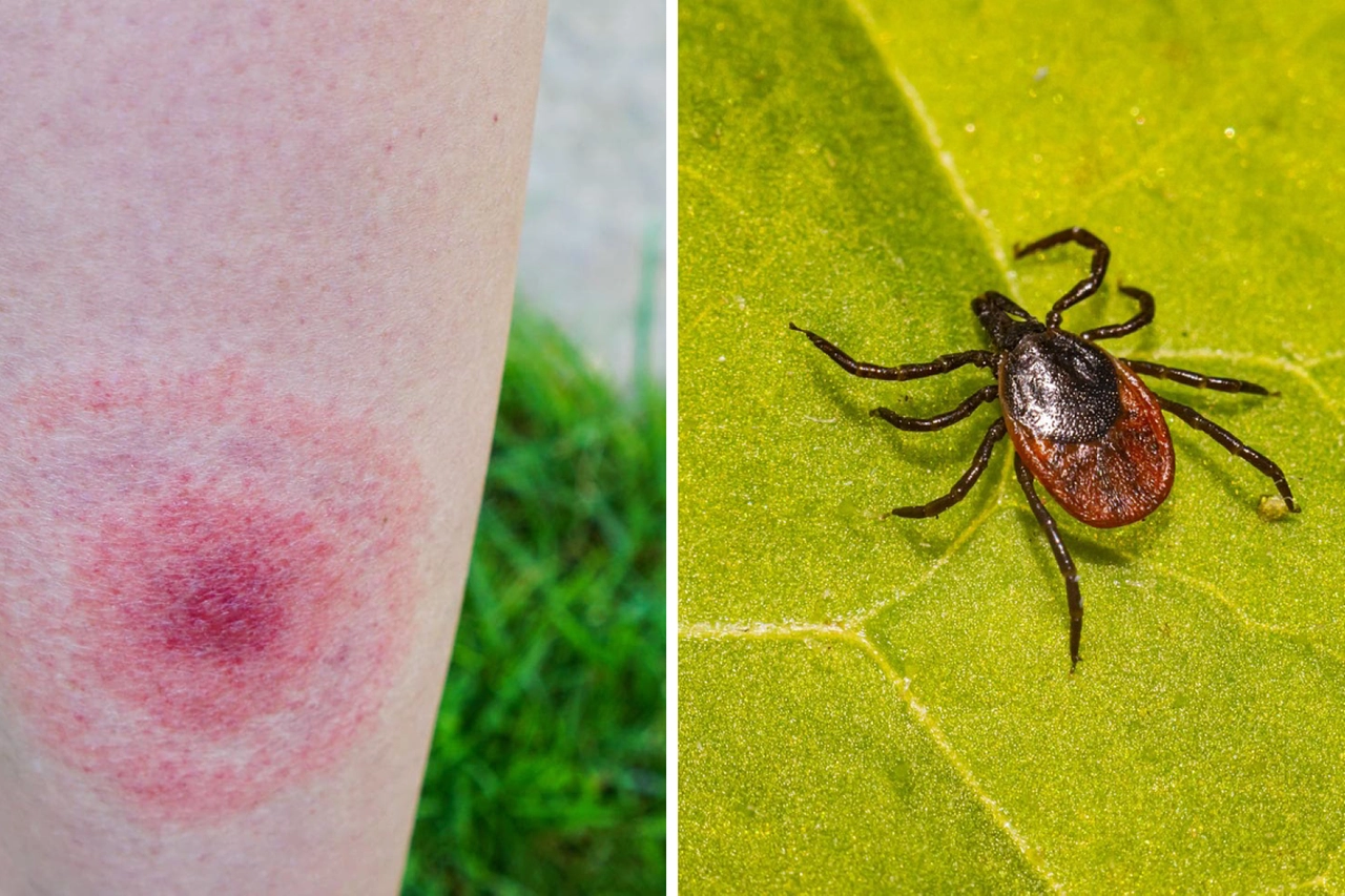 A sinistra, la caratteristiche macchia o papula rossa “a bersaglio” tipica della malattia di Lyme. A destra, una zecca portatrice dell'infezione