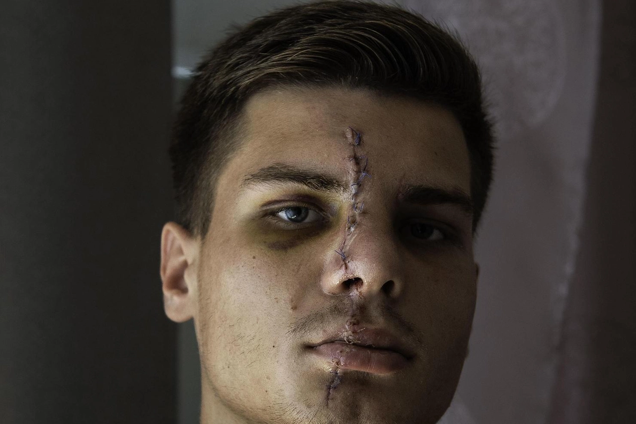 Danylo Shydlovskyi sfregiato il 6 agosto scorso a Milano