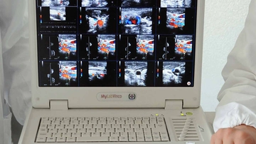 Sclerosi multipla, ogni giorno due diagnosi in Lombardia: donne tre volte più colpite degli uomini