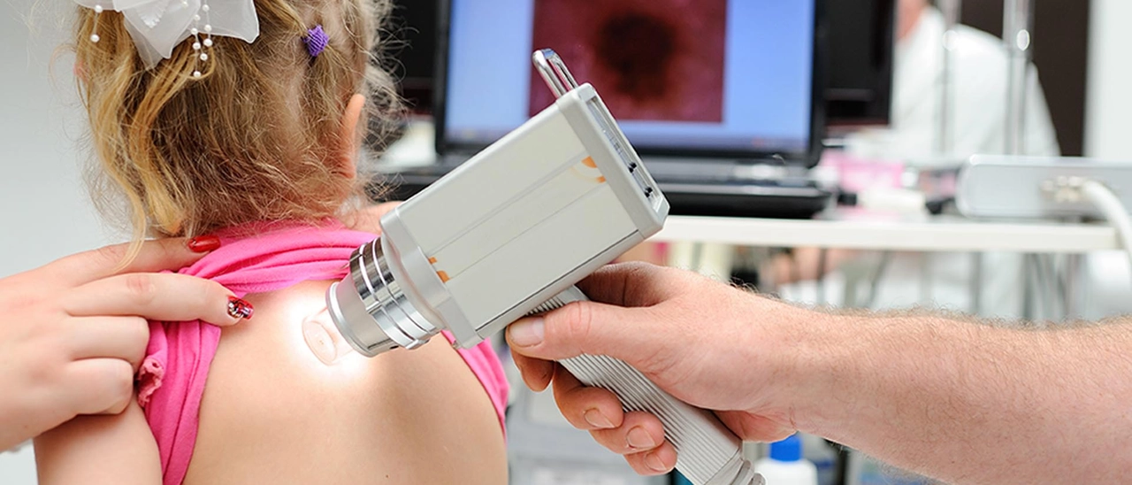 Melanoma e tumori della pelle: consulti gratuiti al San Giuseppe. Quando sono e come accedere