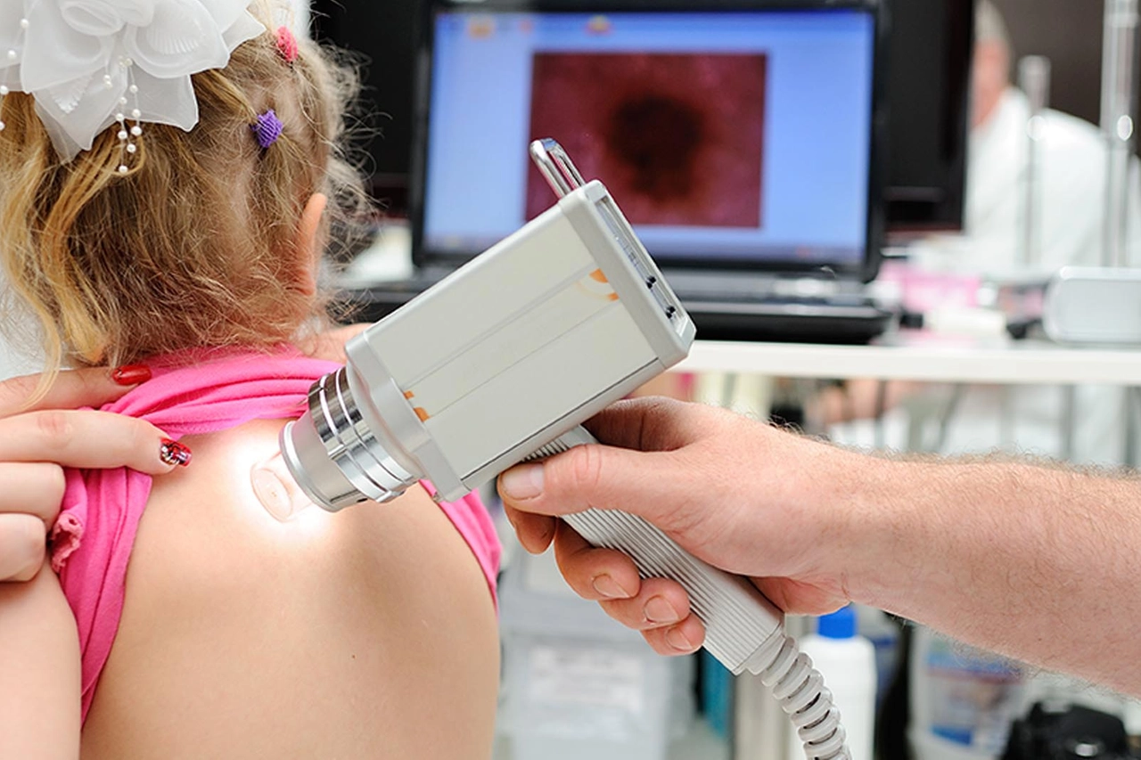 Monitoraggio dei nei: una procedura fondamentale per la prevenzione dei melanomi