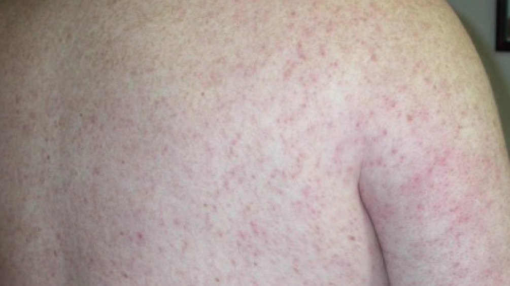 Le manifestazioni cutanee provocate dal virus West Nile