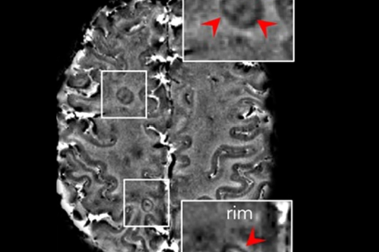Evidenziate in rosso le tipiche placche che si formano nel cervello di una persona colpita da sclerosi multipla