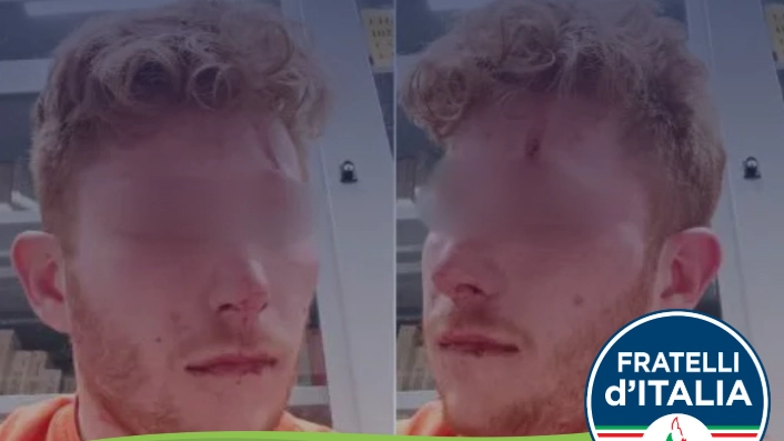 L'immagine del ragazzo dopo l'aggressione pubblicata sul profilo facebook di Carlo Fidanza (FdI)